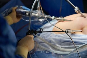 Understanding Laparoscopic Surgery: Benefits, Procedures, and Recovery